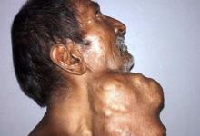 Pria Ini Operasi Pengangkatan Tumor Sebesar Kepala